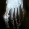 Metatarsal Fracture - Broken Foot