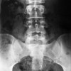 Lumbar Fracture - Broken Low Back